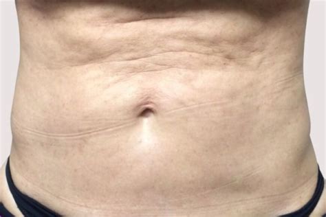 Fibrosis After Lipo: How To Get Rid Of Lumps and Bumps?