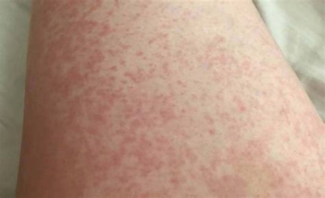 Sepsis Skin Rash Images