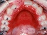 Candida Hard Palate from Dentures • Image • MEDtube.net