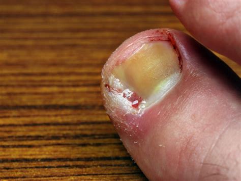 Toenail Bleeding After Stubbing Toe at Richard Bednarz blog