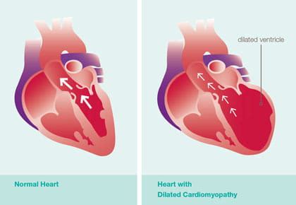 Dilated Cardiomyopathy (DCM) | Pediatric Cardiomyopathy