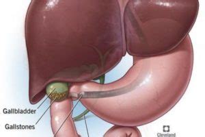 What are Gallstones? Symptoms, Causes, Diagnosis and Treatment