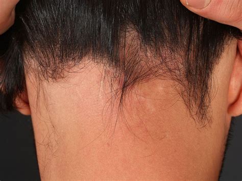 Ophiasis Alopecia: Causes, Symptoms and Treatments - Wimpole Clinic