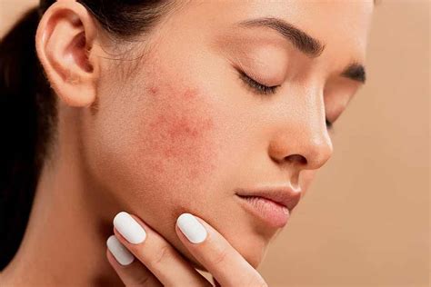 Acne Treatment Mumbai, Pimples, Acne Scars Clinics, Cost India - The ...