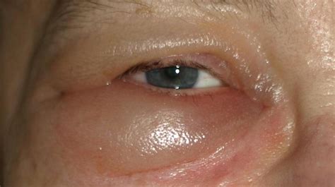 Swollen Lower Eyelid