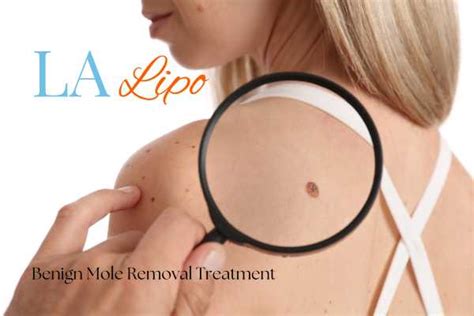 Benign Moles Removal Service