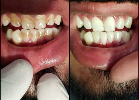 Teeth Scaling & Polishing in Delhi|Low Cost Teeth Cleaning in Delhi