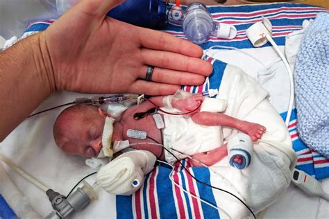 Miraculous Micro-Preemie Baby Shocks the World - Mommy Underground