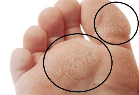 Diabetic Foot Infection | Symptoms, Causes and Treatment