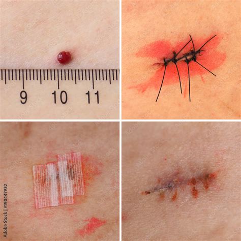 Surgical removal of Pyogenic granuloma on skin Stock Photo | Adobe Stock