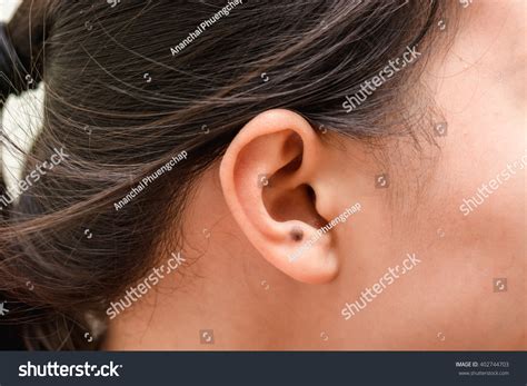 115 Birthmark on ear Images, Stock Photos & Vectors | Shutterstock