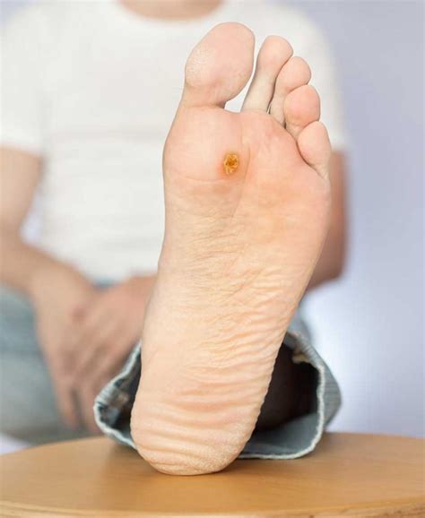 Top 104+ Wallpaper Pictures Of Warts On Feet Latest