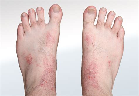 Eczema - Relieve Foot Pain & Leg Pain