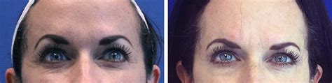 Why does my eyebrow droop after Botox? - Jason Cooper MD