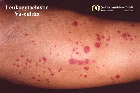 Leukocytoclastic Vasculitis: Small-Vessel Vasculitis... - Academic Dermatology of Nevada