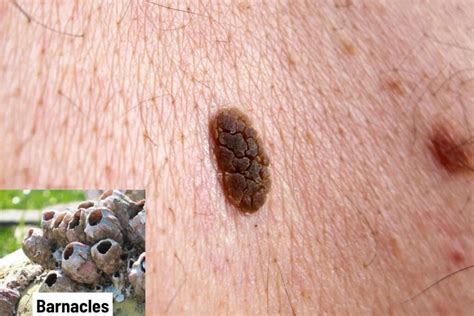 Seborrheic Keratosis (Skin Barnacles): Pictures, Cause, Removal