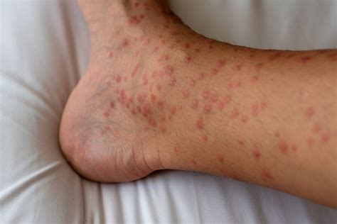 Papular Urticaria: A Guide to This Severe Bug Bite Reaction | The Healthy