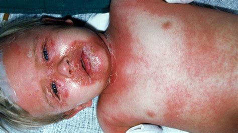 Scalded Skin Syndrome Pictures - the meta pictures