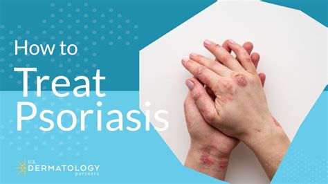 Psoriasis Treatment - Explained by Dermatologist - YouTube