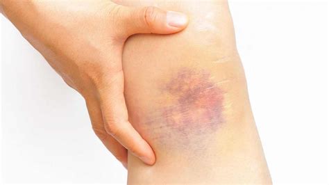 Bruise - Causes, Diagnosis, Treatment, Home Remedy and Healing Time