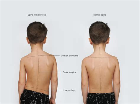 What if my child has scoliosis? - Palermo Physiotherapy & Wellness Centre Oakville