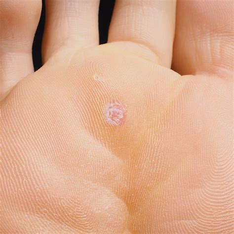 Plantar Wart Root Removal | Bruin Blog