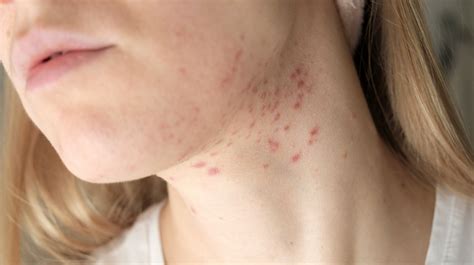 What Should You Do About Stubborn Acne On Your Neck?