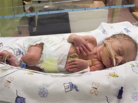 Moderate-to-late preemies likely go home at 36 weeks