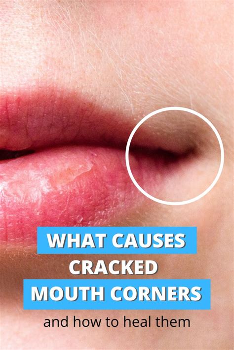 CRACKED LIP CORNERS - what causes them and how to heal fast | Cracked ...