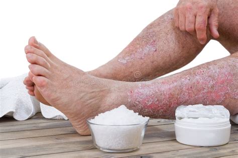 Psoriasis skin lesions stock image. Image of diseased - 108521721