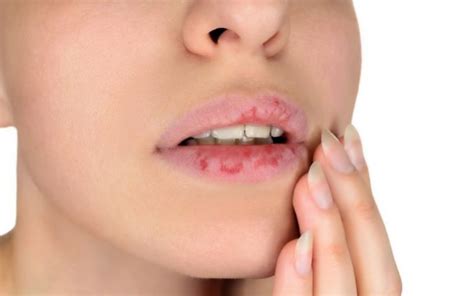 Eczema On Lips: 8 Trusted Treatments - CLEAR SKIN REGIME