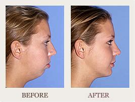 Receding Chin? BOTOX® Might Be A Solution - Dr. Robert Kotler