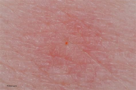 Tiny pinpoint red dots on skin after sunburn - jambasta
