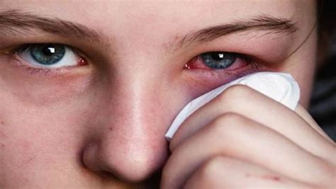 24 Tips How to Treat Red Eyes at Home Without Eye Drops