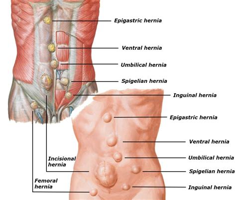 Types Of Hernias Diagram