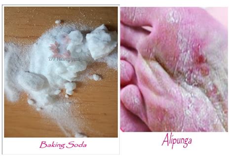 Paano gamitin ang baking soda sa alipunga. – Pamumuhay na SIMPLE at NATURAL