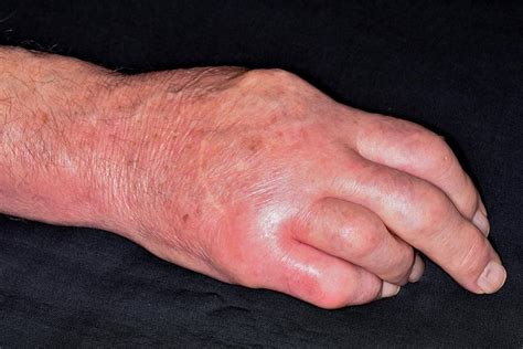 Swollen Hand In Gout Photograph by Dr P. Marazzi/science Photo Library