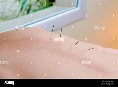 Acupuncture needles on a person's back Stock Photo - Alamy