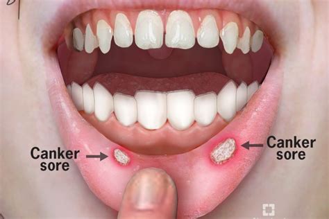 Oral Cancer Sores On Tongue