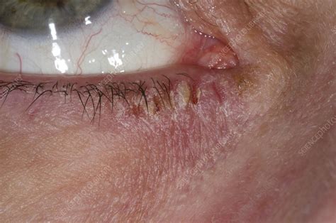 Eczema around the eye - Stock Image - C015/0364 - Science Photo Library