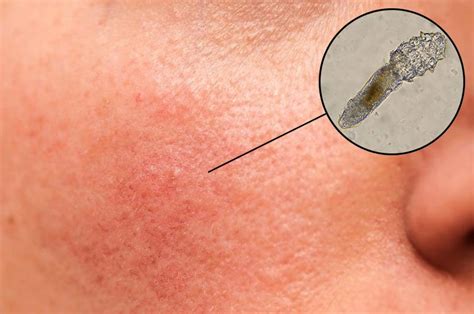 Uncovering the Role of Demodex Mites in Rosacea- Ungex