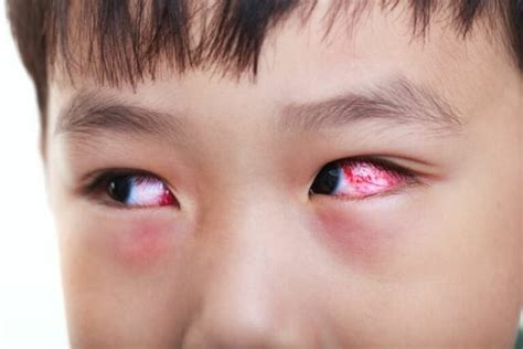 Juvenile Idiopathic Arthritis Uveitis - Eye Condition - The Eye News