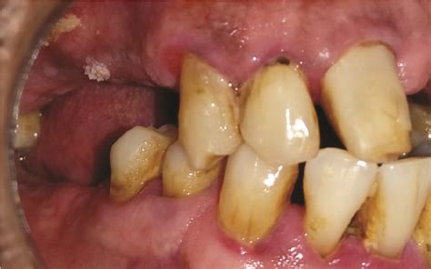 Oral Verrucous Hyperplasia: A Case Report | RGUHS Journal of Dental Sciences | Journalgrid