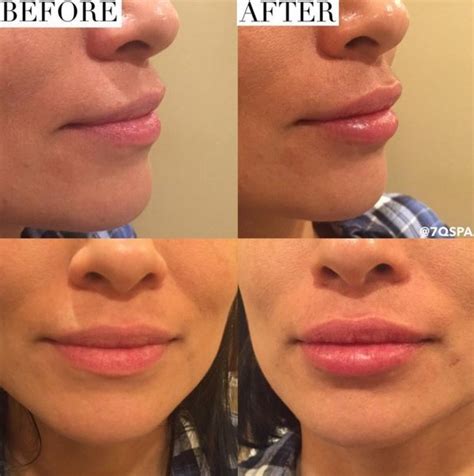 Before After Lip Fillers using Juvederm Ultra Plus XC. 1/2 syringe was ...