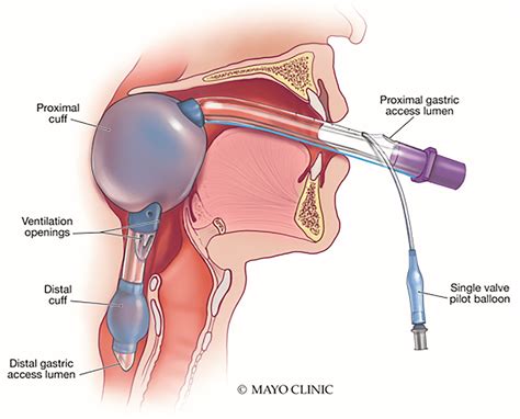 Trick of the Trade: A "Fiberbougie" through a supraglottic airway device (King tube)