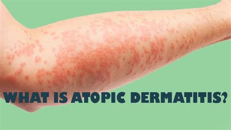 What is Atopic Dermatitis? Syn. Atopic Eczema, Eczema, IgE Dermatitis