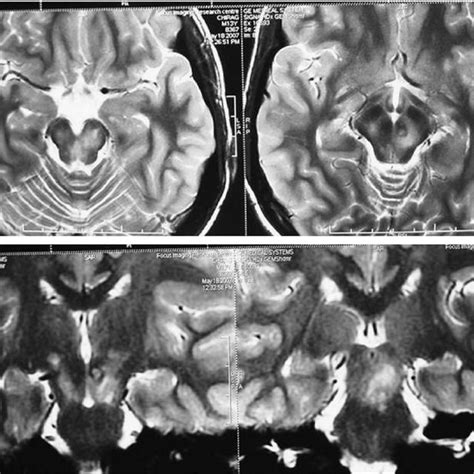 MRI brain showing T1 hypointense and T2/FLAIR hyperintense lesions in... | Download Scientific ...