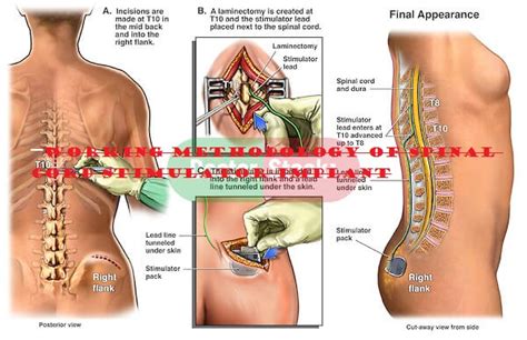 Spinal Cord Stimulator Implant – How it can Help in Pain Relief?