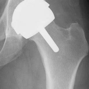 Current indications for hip resurfacing arthroplasty in 2016