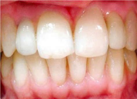 Panoramic radiograph taken after two years. | Download Scientific Diagram